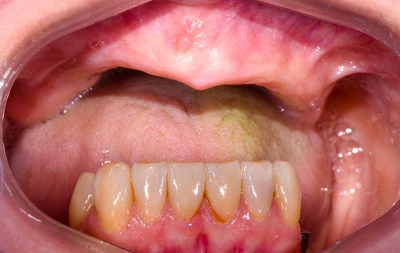 Фото состояния зубов до скуловой имплантации зубов