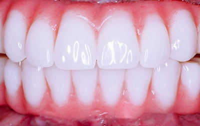 Фото состояния зубов после скуловой имплантации зубов