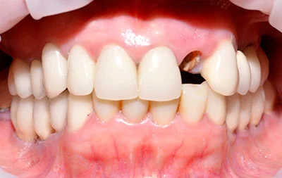 Фото до имплантации одного зуба