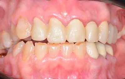 Фото состояния зубов до имплантации и винирования