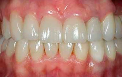 Фото состояния зубов после имплантации и винирования