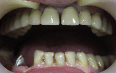 На верхней челюсти зубы были покрыты коронками