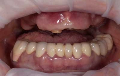 Фото состояния зубов верхней челюсти до имплантации