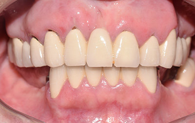 Частичное отсутствие и разрушение опорных зубов под мостовидными протезам