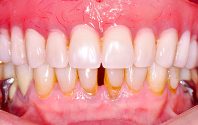 После имплантации зубы за 1 день