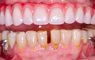 Как выглядят зубы после all-on-4