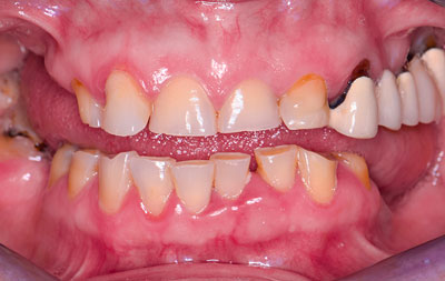 До имплантации зубов на 4 имплантах