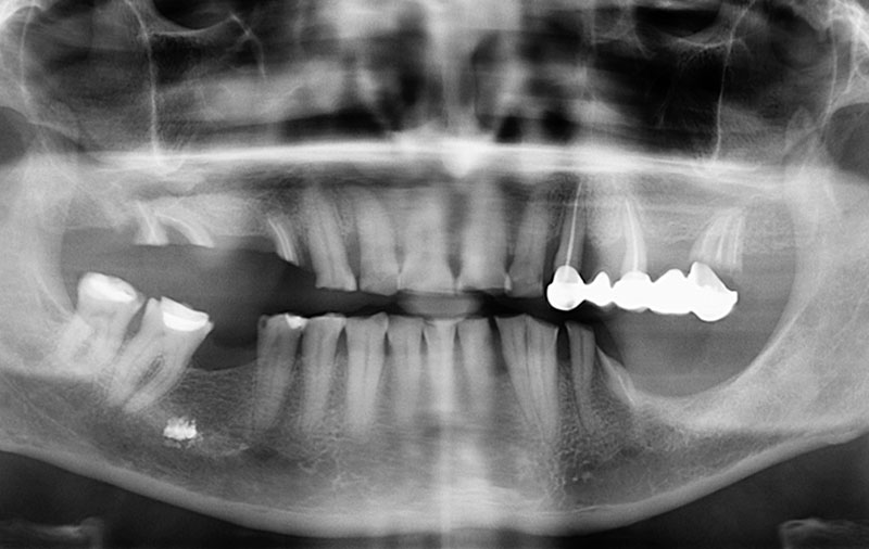Снимок До имплантации зубов на 4 имплантах