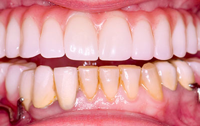 фото зубов после имплантации