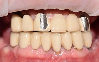 Фото полости рта пациента с полностью отсутствующими зубами