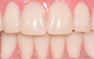 Зубы на верхней и нижней челюстях восстановлены по протоколу комплексной имплантации