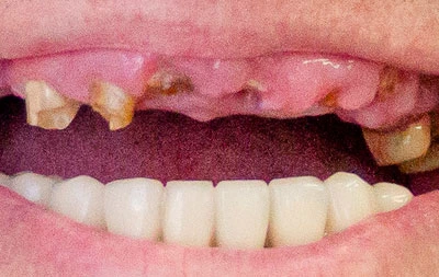 Фото состояния зубов верхней челюсти до операции по их восстановлению