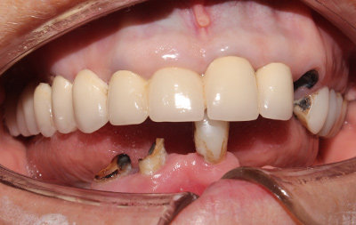 Зубы нижней челюсти полностью отсутствуют