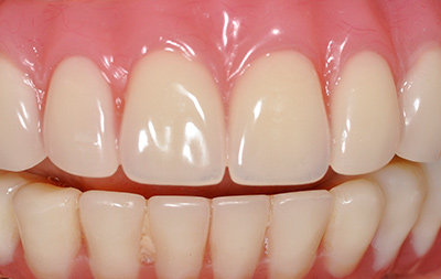 Имплантация зубов нижней челюсти с помощью комплексного протокола