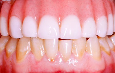 Зубы после имплантации all-on-6