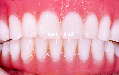 Установка зубных имплантов на нижней челюсти
