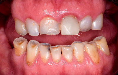 Фото состояния зубов пациента до операции