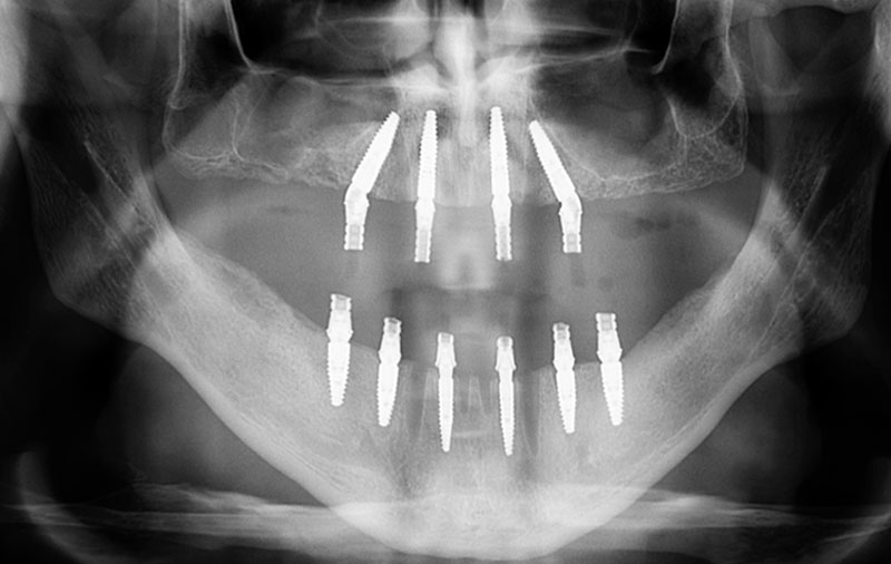 Снимок Фото зубов после установки протезов