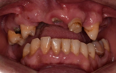 Фото разрушенных зубов с пародонтитом до имплантации