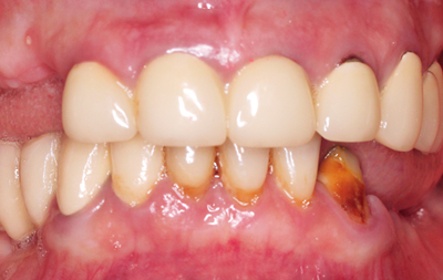 Множественное отсутствие зубов, разрушение мостовидных протезов и опорных зубов под ними