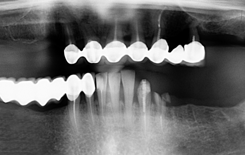 Снимок Множественное отсутствие зубов, разрушение мостовидных протезов и опорных зубов под ними