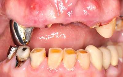 фото зубов до лечения