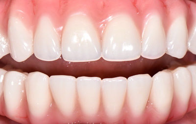 фото зубов после перепротезирования