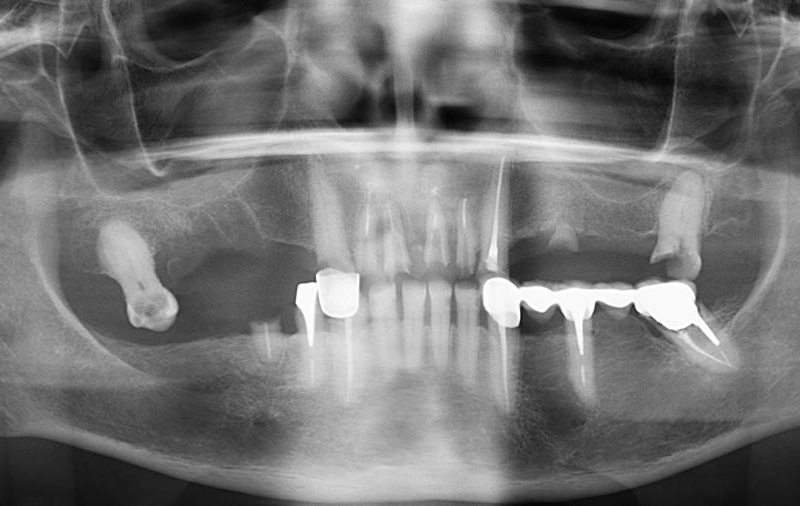 Снимок фото зубов до лечения