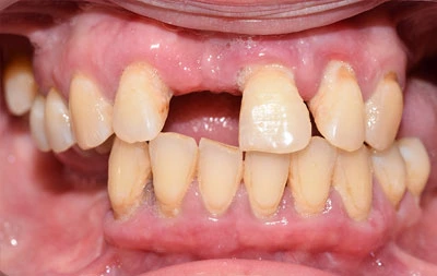 Фото зубов с множественными проблемами