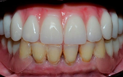 Фото после установки постоянных зубных протезов с опорой на имплантах