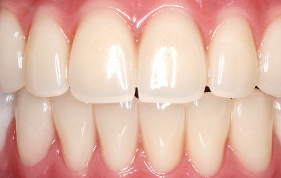 Проведено восстановление зубов на двух челюстях