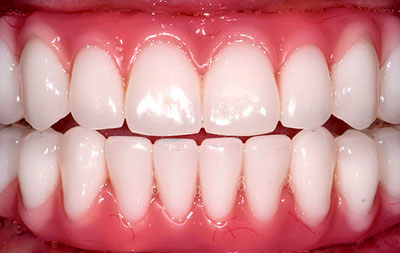 Фото после проведения комплексной имплантации зубов