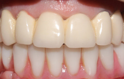 Зубы на нижней челюсти восстановлены при помощи протокола all-on-6
