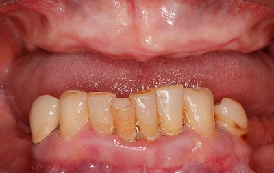 Фото отсутствия зубов у пациента