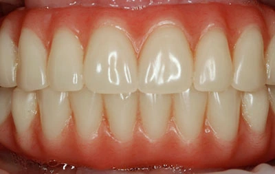 Фото после установки адаптационных зубных протезов на импланты