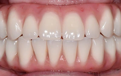 Фото после замены адаптационных зубных протезов постоянные