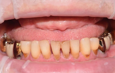 Фото состояния зубов до установки комплекса имплантов