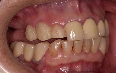 Фото отсутствующего жевательного зуба
