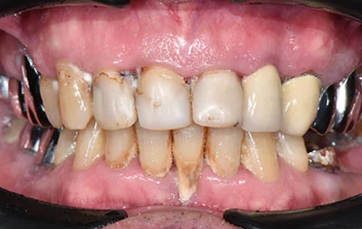 Фото проблем с зубами пациента до имплантации