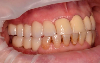 Фото после восстановления зуба имплантами Straumann