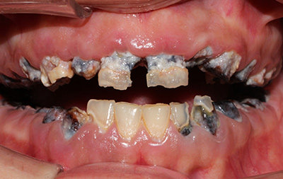 Разрушенные зубы