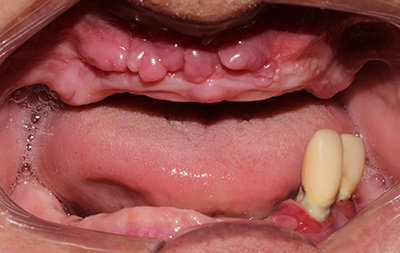Отсутствие зубов на верхней челюсти, на нижней осталось всего 2 зуба