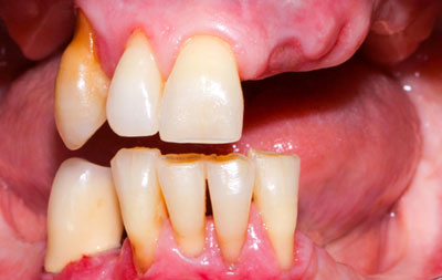 Проблемы с зубами перед имплантацией