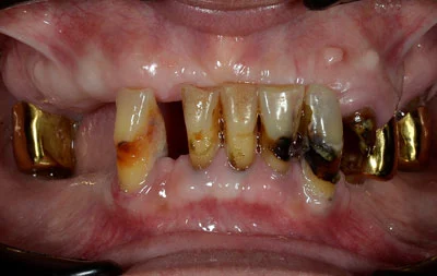 Фото перед проведением имплантации зубов