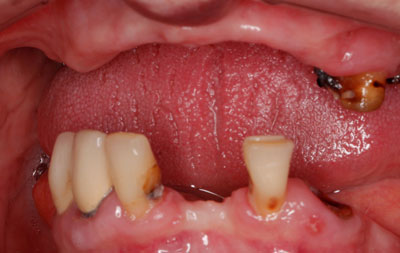 практически полное отсутствие зубов, острая атрофия костной ткани и деформация прикуса