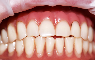 Несъемный адаптационный протез был установлен сразу после проведения базальной имплантации зубов