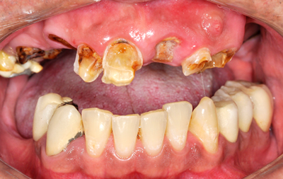 Разрушение зубов на верхней челюсти