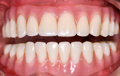 имплантация зубов на верхней и нижней челюсти по технологии All-on-4