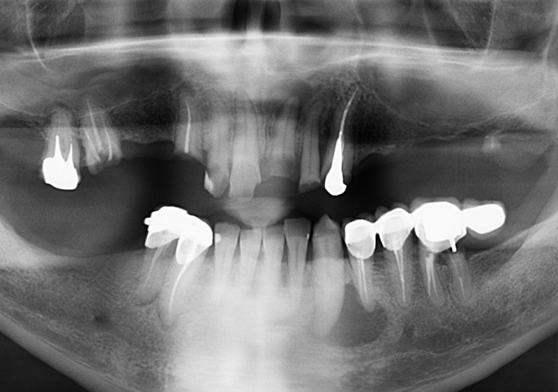 Снимок Разрушение зубов на верхней челюсти