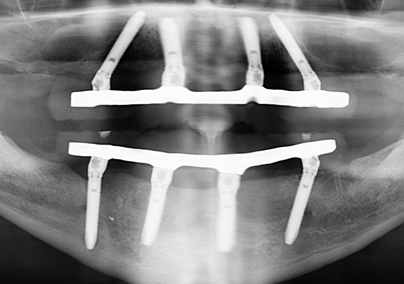 Снимок имплантация зубов на верхней и нижней челюсти по технологии All-on-4